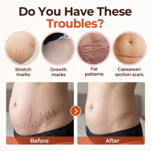 Biancat® SilkStretch Natural Stretch Mark & Scar Oil