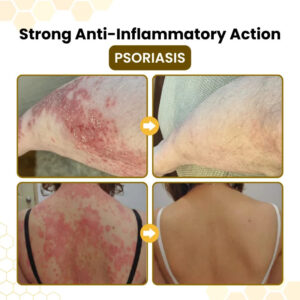 Ximonth® PsoriaSoothe Skin Care Cream