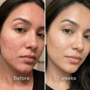 Clinical Acne Scar Repair Stick™