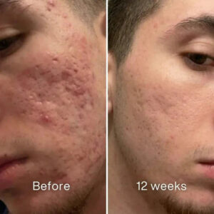 Clinical Acne Scar Repair Stick™