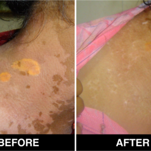vitiligo-38